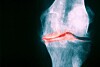 Osteoporóza ke stárnutí patří.
